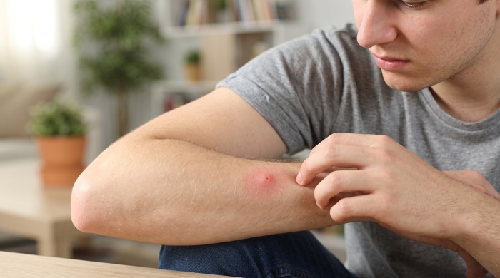 picadura de mosquito en antebrazo de persona